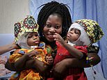 Conjoined twins, 2, separated at a Vatican paediatric hospital