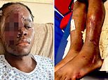 NHS worker suffers horrific injuries in ‘racist hit-and-run attack’ by yobs