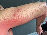 Mother’s arm erupts in agonising red rash after getting AstraZeneca’s Covid vaccine