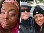 Woman suffers horrific burns after her husband accidentally set her on fire