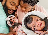 Baby girl born with condition called Congenital Melanocytic Nevus that causes dark spots on body 